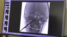 Cứu sống một thiếu niên bị dao đâm xuyên má lên hộp sọ