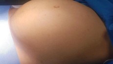 Khối u to bất thường khiến nhiều người lầm tưởng bệnh nhân có bầu 8 tháng. Ảnh: PLO