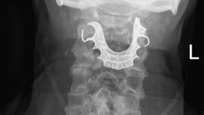 Phát hiện răng giả bị mắc kẹt trong cổ họng 8 ngày sau phẫu thuật