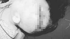 Vùng đầu của bé trai bị tổn thương nặng do chó cắn. Ảnh: Infonet