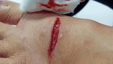 Vết thương của một người dân bị chó cắn. Ảnh: Dân trí