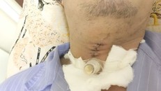 Cứu sống người đàn ông bị đá mài bắn vào cổ