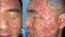 Mua thuốc bôi trên mạng, nam thanh niên mọc mụn đầy mặt
