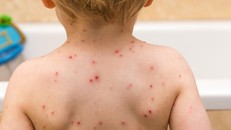 Bệnh sởi khiến 140.000 người trên thế giới tử vong