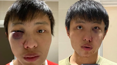 Những viết thương trên mặt của Jonathan Mok. Ảnh: Facebook