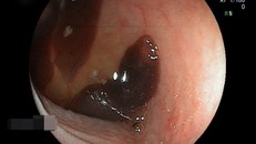 Ổ sán lá đang bám chặt vào thành ruột của bệnh nhân H. Ảnh: Bệnh viện cung cấp