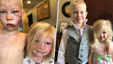 Cậu bé Bridger Walker nhận 90 mũi khâu trên mặt sau khi cứu em gái mình.