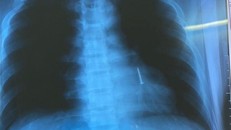 Nội soi gắp đinh sắt dài 3 cm trong phế quản bệnh nhân