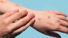 Chủ động giám sát, phát hiện sớm ca bệnh, nguồn lây đậu mùa khỉ