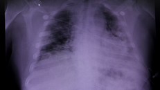 Mỹ loại bỏ yếu tố chủng tộc khỏi quy trình khám phổi