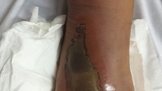 Vết hoại tử trên chân của bệnh nhi Nguyễn Duy Kh. đang hồi phục tốt