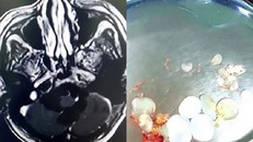  Trứng sán dây lúc nhúc trong não người đàn ông ăn thịt sống