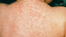  TP.HCM: Cảnh báo bệnh sởi quay trở lại