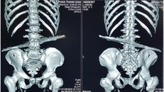 BV huyện Củ Chi: Cứu sống bệnh nhân bị cọc sắt 40cm đâm xuyên bụng