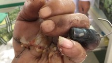 Nối ghép bàn tay bị cưa đứt lìa cho bệnh nhân