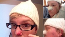 42 tuổi phẫu thuật tới 86 lần vì ung thư da