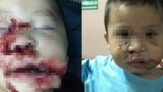 Phẫu thuật tạo hình cho bé trai 2 tuổi bị chó cắn nát mặt