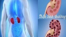 Những dấu hiệu thông báo bạn đã bị suy thận