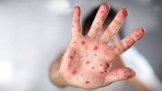 3 triệu chứng sớm báo hiệu bệnh tay chân miệng diễn biến nặng