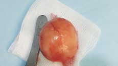 Người đàn ông 48 năm chung sống cùng ...3 tinh hoàn