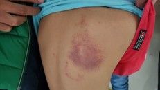 Làm sai bài, học sinh lớp 2 bị cô giáo đánh tím lưng