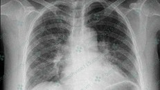 Kiểm tra X-quang phổi bệnh nhân không ghi nhận gì bất thường