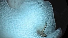 Chiếc đinh vít được lấy ra