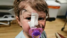 Bé gái 2 tuổi suýt mù mắt do bị chó cắn