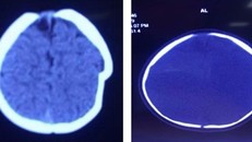 Hình ảnh lún sọ não trước mổ. Ảnh: BSCC.
