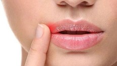 Virus bệnh tình dục gây ra những vết rộp, lở trên miệng có thể được ngăn ngừa bằng một loại thuốc trị bệnh thận - (ảnh minh họa từ internet)