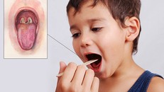 Những điều cần biết về bạch hầu - căn bệnh có thể gây tử vong trong 6 ngày