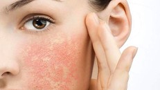 Cách khắc phục dị ứng do kem chống nắng