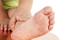 Bác bỏ thông tin thiếu thuốc điều trị bệnh tay chân miệng