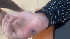 Mông Cổ phát hiện ca bệnh than ở người