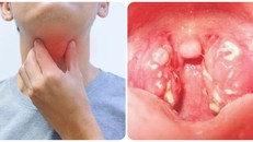 Nguy cơ bạch hầu lây nhiễm thành dịch trên diện rộng là thấp