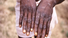 CDC châu Phi báo cáo hơn 18.700 ca mắc hoặc nghi mắc đậu mùa khỉ