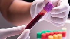 Chưa có bằng chứng khoa học về lọc máu có thể phòng ngừa các bệnh liên quan đến mỡ máu, đột quỵ