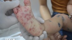 Các nốt phát ban của bệnh nhi bị tay chân miệng. Ảnh: Nguyên Dung/TTXVN.