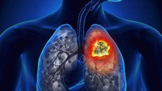 Điều trị miễn dịch buổi sáng giúp bệnh nhân ung thư phổi sống lâu hơn