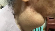 Khối u tuyến giáp khổng lồ gây khó khăn trong hít thở và sinh hoạt hàng ngày cho bệnh nhân.