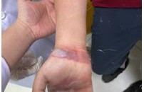 Suýt mất tay vì nhờ "thần y" bó lá chữa gãy xương