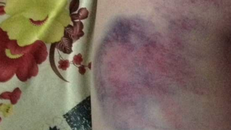 Đắk Lắk: Giáo viên đánh bầm tím mông học sinh lớp 4