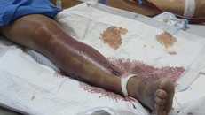 Ăn tiết canh lợn, người đàn ông nhập viện trong tình trạng nguy kịch