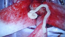 Ký sinh trùng trong não của bệnh nhân