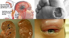 Biến chứng khủng khiếp của căn bệnh cướp mạng gần 30.000 người Việt mỗi năm