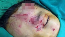 Những vết thương trên mặt bé trai khá sâu và nguy hiểm