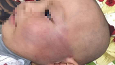 Vụ bé trai 19 tháng bị tát sưng mặt: Đề nghị xử lý bảo mẫu