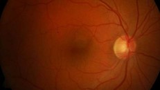 Một hình ảnh đáy của một võng mạc khỏe mạnh.