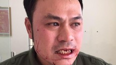 Vụ nhân viên an ninh sân bay bị đánh gãy răng: Xác định đối tượng hành hung bỏ trốn