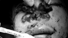 Hình ảnh tình trạng đa chấn thương của bệnh nhân bị tai nạn nổ bình ga